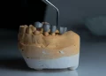 Root Canal