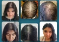 Hair Transplant in Turkey