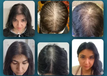 Hair Transplant in Turkey